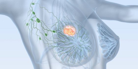 Brustkrebs
