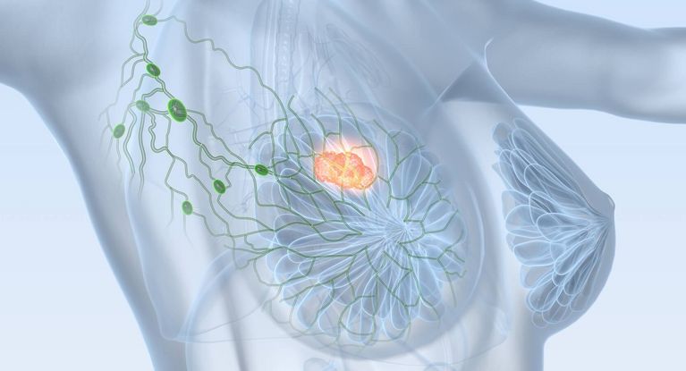 Brustkrebs